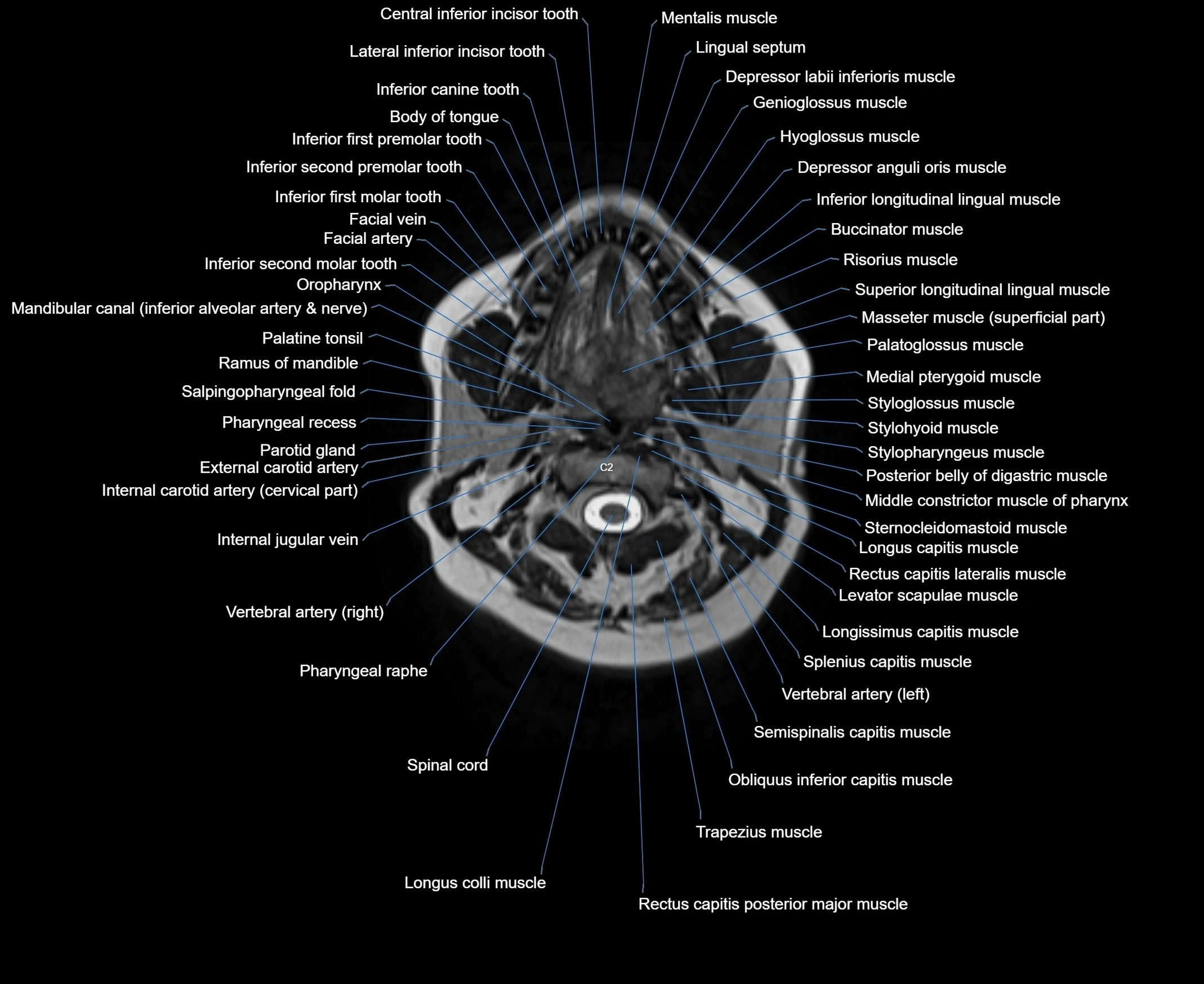 MRI Neck 3D labelled cross section anatomy axial 3t image-00001-00034.webp